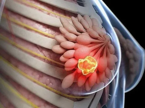 8 kiểu phụ nữ dễ bị K vú nhất: Xem bạn có trong số đó?