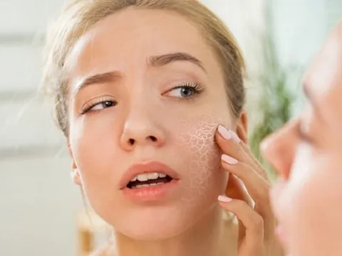 Điều gì khiến da khô điều trị mụn mãi không khỏi?