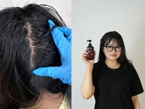 Trải nghiệm hết gàu ngứa của nữ sinh viên năm cuối: Kết quả bất ngờ từ dầu gội thảo dược?