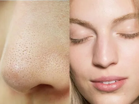 Ghim ngay 3 tips trị mụn cám vừa rẻ vừa hiệu quả chẳng tốn tiền đi spa