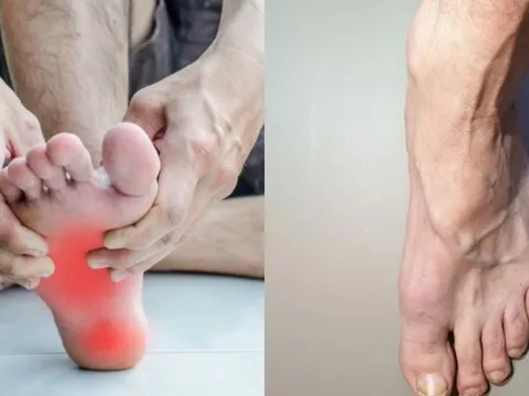 Hai bàn chân xuất hiện 5 dấu hiệu lạ, coi chừng gan đang 'kêu cứu': Hãy đi khám ngay đừng chủ quan