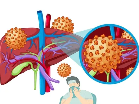 Nhiều người bị Viêm Gan B bởi lý do này