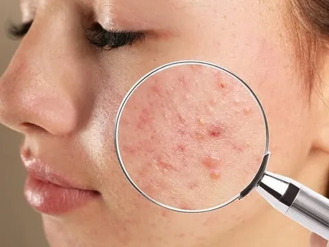 Cẩm nang chăm sóc các loại mụn ẩn nàng nên biết