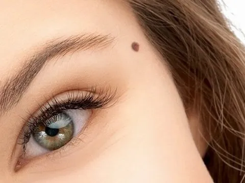 Những nốt ruồi đại phú quý: Có thì giữ, tuyệt đối đừng tẩy xóa