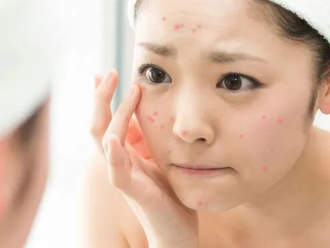 Mẹo nhỏ giúp bạn lấy lại làn da sạch mụn chỉ sau một đêm