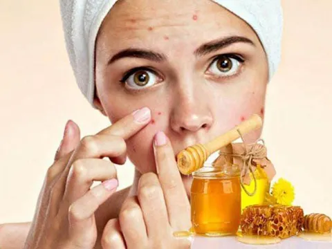 Mật ong hoàn toàn có thể trở thành “trợ thủ” cho da mụn nếu nàng nắm rõ những điểm sau