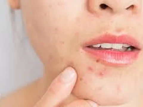 Nếu còn mắc 4 sai lầm này hàng ngày da bạn sẽ càng nổi nhiều mụn