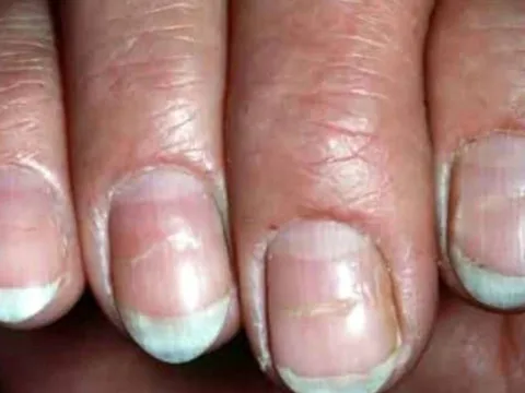 5 dấu hiệu bất thường trên móng tay cảnh báo ung thư: Đừng chủ quan kẻo phát hiện quá muộn
