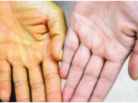5 dấu hiệu cảnh báo bệnh gan của bạn đã đi vào giai đoạn nặng: Có 1 cũng nên đi khám sớm