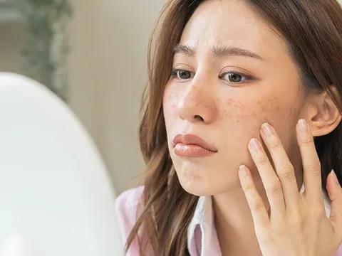 Sai lầm khiến tình trạng nám và đốm đen trở nên trầm trọng