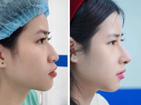 Nâng Mũi Cấu Trúc Cùng Bsi Nguyễn Xuân Long: Tối Ưu Hồi Phục Bằng Kỹ Thuật Xâm Lấn Tối Thiểu
