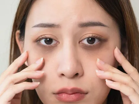 10 cách 'xóa sổ' quầng thâm mắt hiệu quả tại nhà, không cần mỹ phẩm đắt tiền hay ra spa