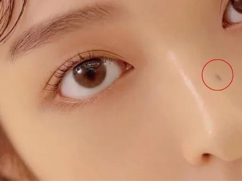 3 vị trí mọc nốt ruồi báo hiệu mệnh phú quý: Cả đời không lo thiếu tiền, càng lớn tuổi càng giàu sang