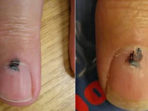 Cảnh báo sức khỏe: 6 bộ phận màu đen thường báo hiệu nguy cơ ung thư, đừng chủ quan!