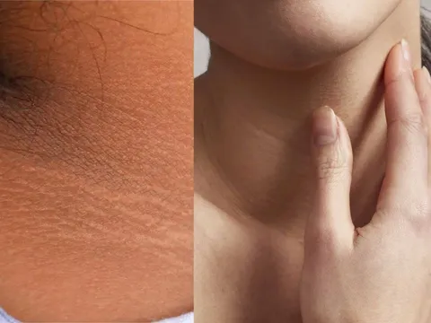 Nhìn thấy dấu hiệu này trên da, cẩn thận Tiểu Đường tới gần