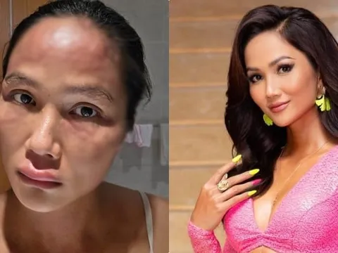 H'Hen Niê mắc bệnh sau sinh, khuôn mặt biến dạng khó nhận ra
