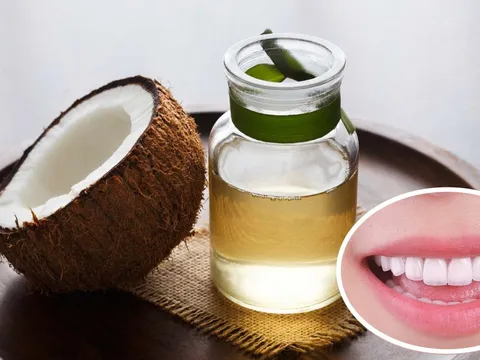 Súc miệng bằng dầu dừa có 3 lợi ích tuyệt vời, ai cũng cần