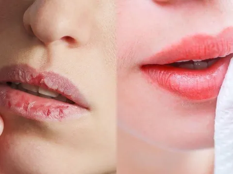 Cách trị môi khô nứt nẻ bằng nguyên liệu sẵn có tại nhà để mùa đông khô hanh nhưng môi vẫn căng mọng