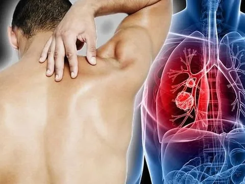 5 thứ đột nhiên xuất hiện chứng tỏ bệnh K "không rủ cũng tới"