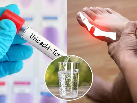 4 cách đào thải axit uric ra khỏi cơ thể nhanh chóng