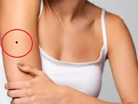 5 vị trí nốt ruồi "xấu thậm tệ", phá đường công danh, tình duyên bạn cần tẩy gấp