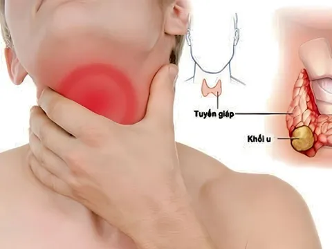 7 dấu hiệu sớm của K tuyến giáp, nhiều người chủ quan bỏ qua