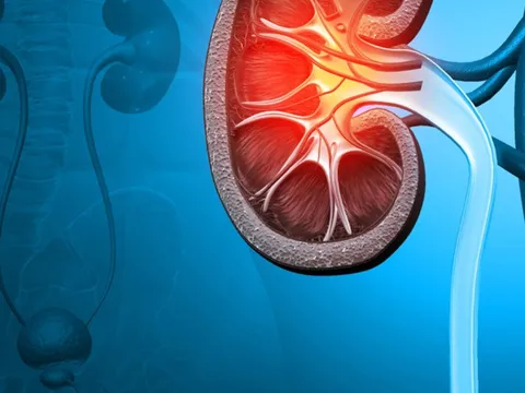 5 dấu hiệu sớm cảnh báo suy thận giai đoạn đầu: Đừng chủ quan kẻo cả đời chạy thận