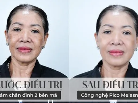 Pico Melasma - Bước tiến công nghệ vượt bậc giúp LG Clinic vươn tầm trong lĩnh vực điều trị nám da