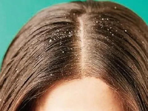 4 mẹo cơ bản giúp bạn nói lời "tạm biệt" với gàu