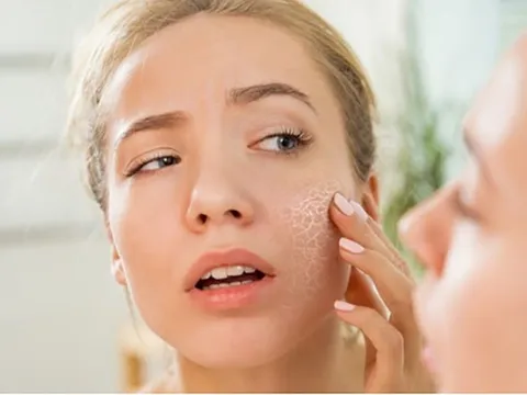 Thói quen khiến da khô nẻ, bong tróc mùa đông