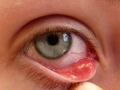 5 bệnh nhiễm trùng mắt thường gặp nhất trong mùa lây nhiễm, cần đặc biệt lưu ý