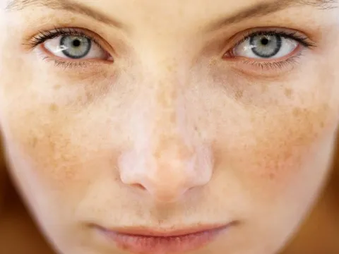 3 loại nước ép giàu vitamin A và C chăm sóc làn da và trị nám cực hiệu quả