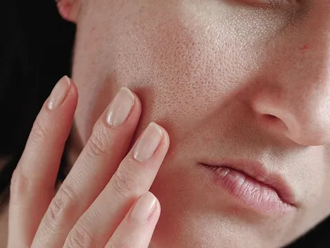 6 mẹo chăm sóc da giảm dày sừng nang lông