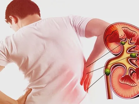 5 dấu hiệu cảnh báo suy thận sớm, nhiều người chủ quan phải chạy thận cả đời