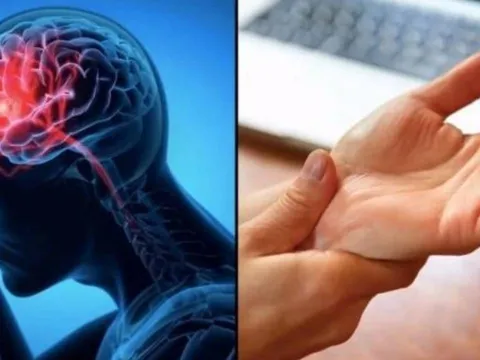 Cảnh báo đột quỵ: Dấu hiệu nhận biết trước 1 tuần, tuyệt đối không được bỏ qua