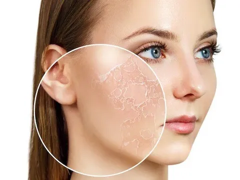 7 cách "đánh bay" mụn cám đơn giản