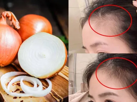 Mẹo sử dụng hành tây giúp tóc con mọc tua tủa, càng dùng tóc càng dày và bóng mượt
