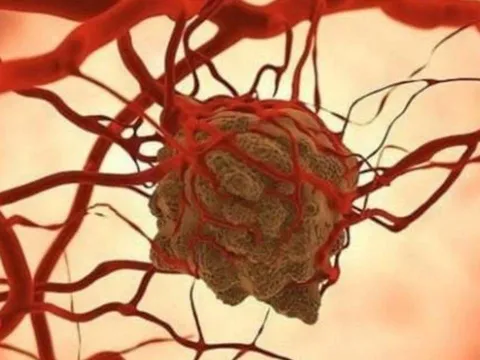 Tế bào ung thư sợ nhất điều gì? Chuyên gia chỉ ra loạt “điểm yếu chí mạng” ngăn chặn và tiêu diệt ung thư