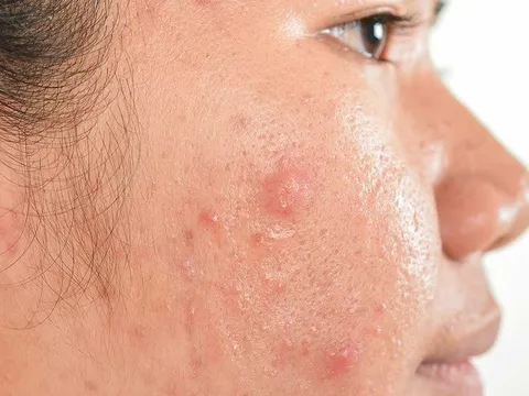 Cách chăm sóc da mụn đúng cách trong mùa đông