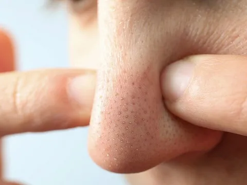 3 mẹo đơn giản giải quyết nỗi lo mụn đầu đen cho nàng