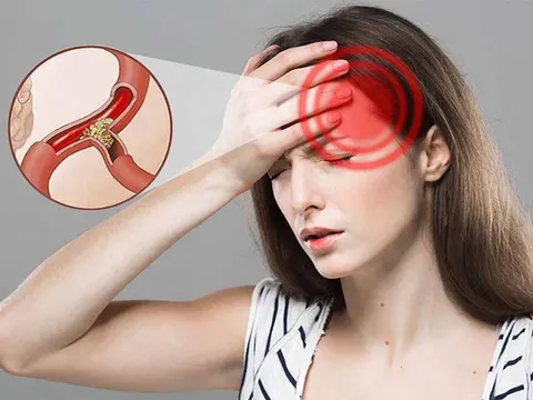 5 nguy cơ của bệnh thiếu máu não và cách phòng ngừa