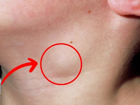 3 dấu hiệu bất thường ở vùng cổ cảnh báo K: Nhiều người chủ quan đã quá muộn