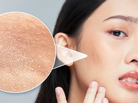 Cách để da căng bóng, mềm mịn, trời khô lạnh không lo nứt nẻ