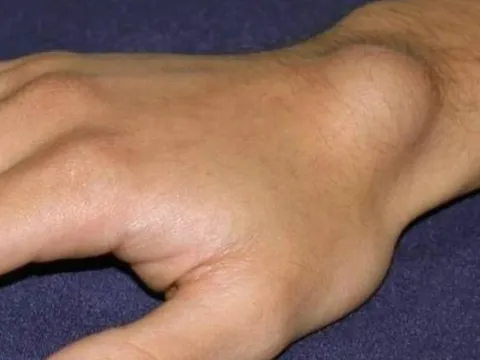 Cảnh báo ung thư giai đoạn cuối: Đừng bỏ qua 4 dấu hiệu bất thường trên cơ thể