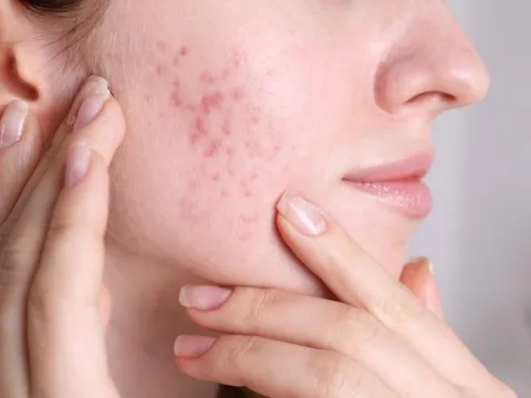 Thâm mụn và lộ trình chăm sóc giúp da phục hồi nhanh hơn