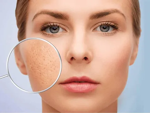 5 cách cải thiện lỗ chân lông to theo bác sĩ da liễu