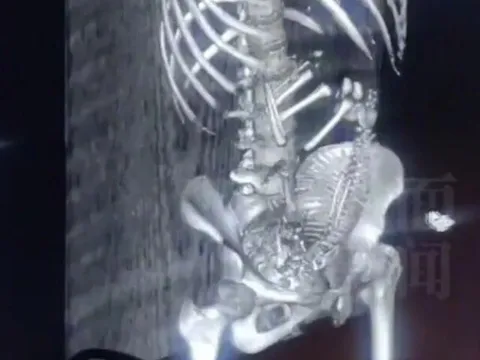 Con gái đi học về xuất hiện bất thường ở vùng kín, mẹ vội đưa vào viện khám, kết quả chụp CT khiến bác sĩ tái mặt