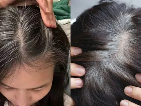 3 nhóm người dễ bị tóc bạc sớm, ngoài 30 tuổi tóc đã bạc trắng