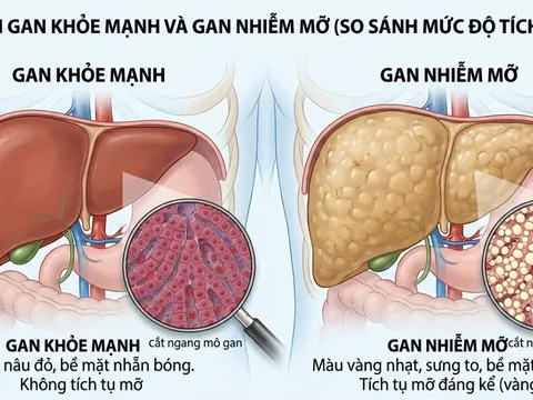 Gan nhiễm mỡ tăng nhanh ở người Việt: Bác sĩ chỉ ra 3 thói quen quen thuộc nhiều người mắc phải