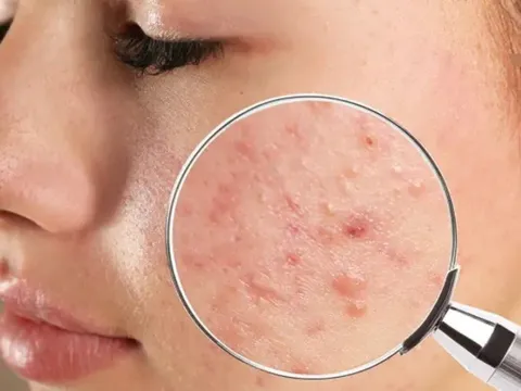 Bạn có đang tiêu thụ đường quá nhiều? Đây là 4 dấu hiệu cho thấy